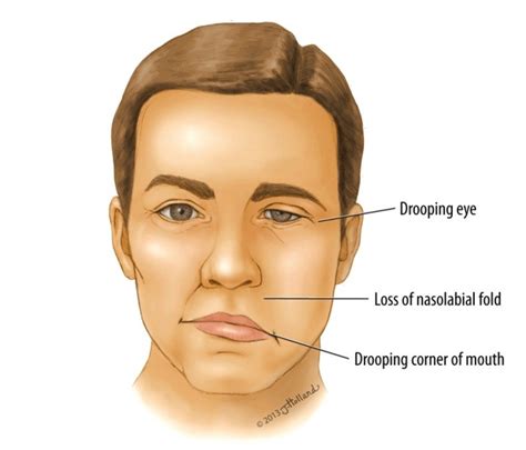 is bell's palsy permanent or temporary